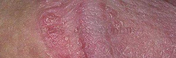 Dry skin and boils on the head of the penis after using a baking soda