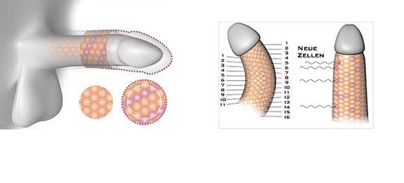 Results of penis enlargement surgery