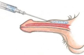 A dangerous way to enlarge your penis is by using Vaseline injections